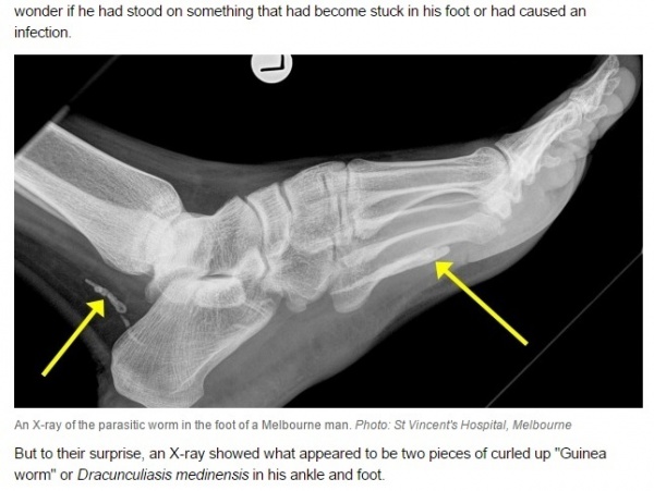 【海外発！Breaking News】数年後に足首が腫れて感染が発覚。脅威の寄生虫「ギニアワーム」。（豪）