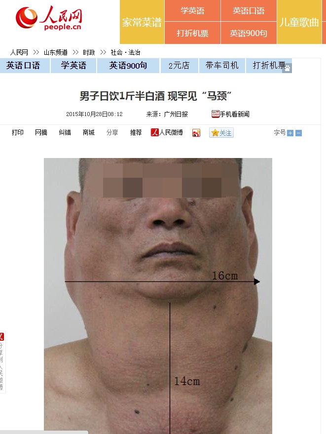 顔に巨大な脂肪塊ができた中国の男性（画像はsd.people.com.cnのスクリーンショット）