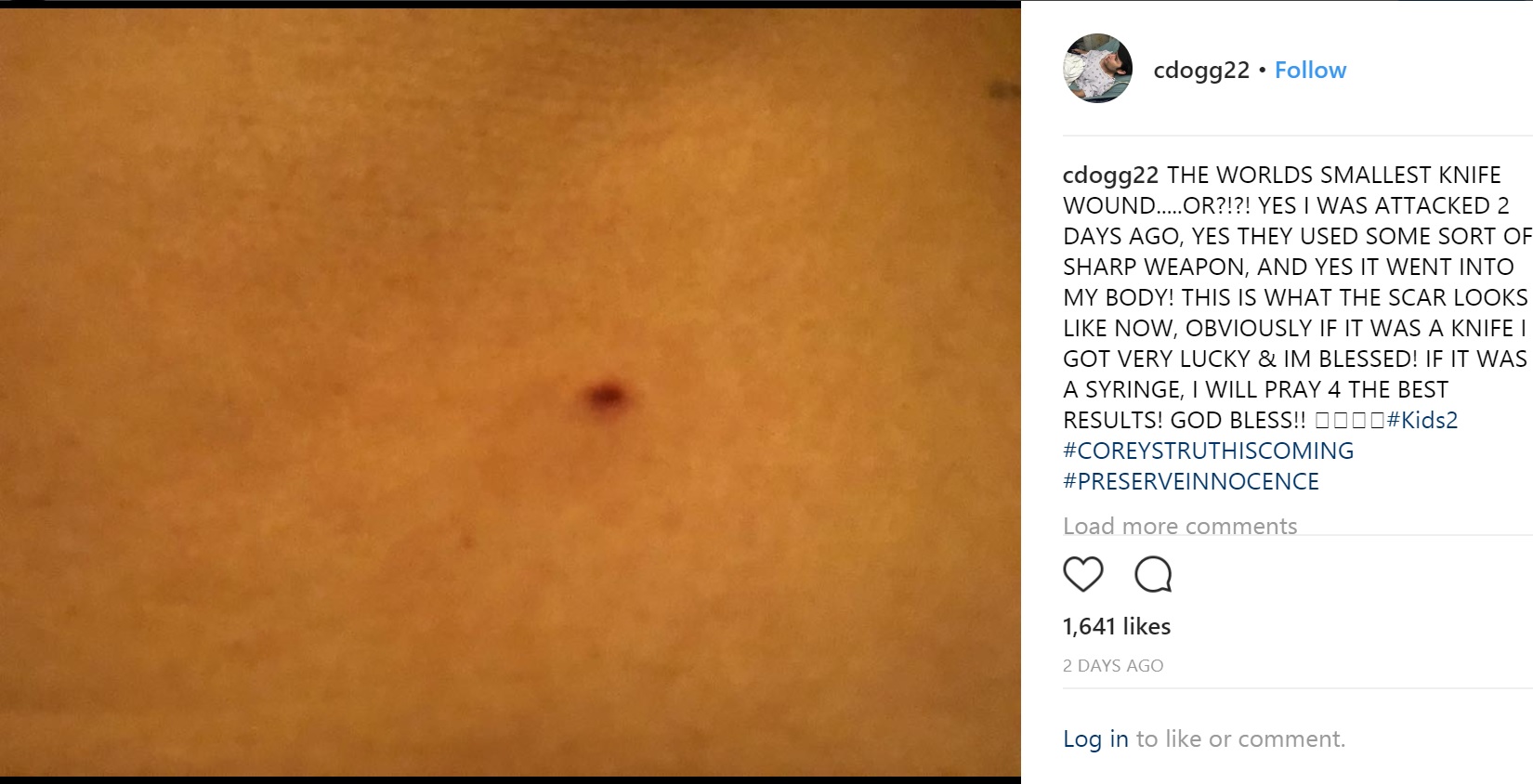 コリーが公開した傷（画像は『Corey Feldman　2018年3月30日付Instagram「THE WORLDS SMALLEST KNIFE WOUND.....OR?!?!」』のスクリーンショット）