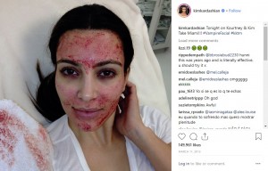 バンパイア・フェイスリフトの施術を受けるキム・カーダシアン（画像は『Kim Kardashian West　2013年3月11日付Instagram「Tonight on Kourtney ＆ Kim Take Miami!!!」』のスクリーンショット）