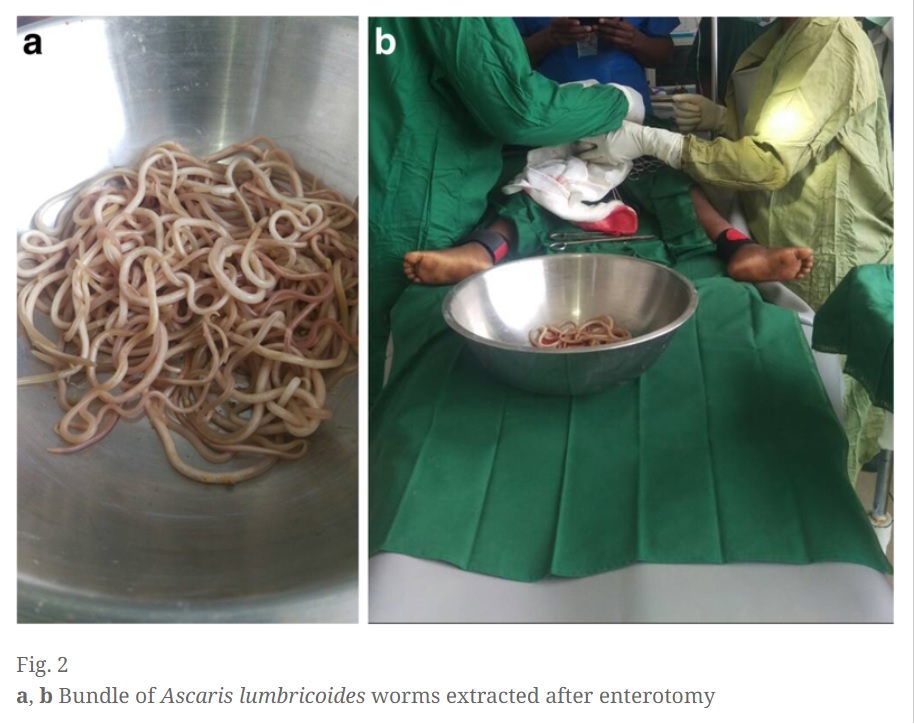 4歳男児の腸内に寄生していた回虫（画像は『Journal of Medical Case Reports　2019年5月24日付「Small bowel obstruction complicating an Ascaris lumbricoides infestation in a 4-year-old male: a case report」』のスクリーンショット）