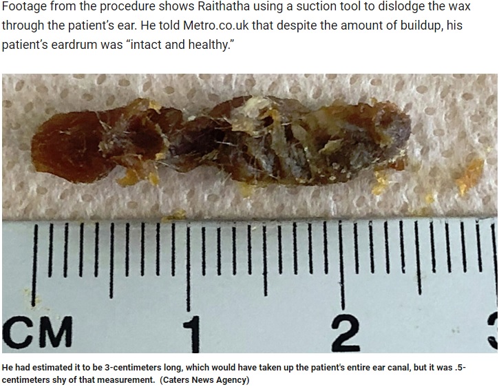 男性の耳から除去された2.5センチの耳垢（画像は『FOX News　2019年6月19日付「Earwax clump clogging entire ear canal removed from patient: ‘Look at that!’」（Caters News Agency）』のスクリーンショット）