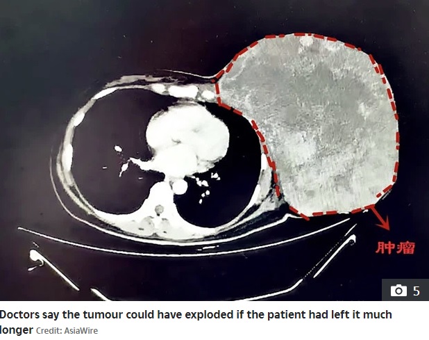 2年間放置されバスケットボールより大きくなった腫瘍（画像は『The Sun　2019年10月24日付「DEADLY DELAY Woman with breast tumour so big she had to hold it up finally goes to hospital after 2 years of herbal ‘treatments’」（Credit: AsiaWire）』のスクリーンショット）