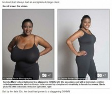 【海外発！Breaking News】爆乳も大きな悩み。手術でやっと人並みのバストを手に入れた女性。（米）