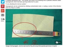 【海外発！Breaking News】幼い頃に生きたカエルを食べていた29歳女性、脳から8cmの寄生虫。（中国）