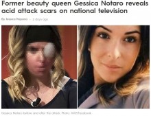 【海外発！Breaking News】ストーカーから酸攻撃を受けた元ミス・イタリア候補の女性、心境を吐露