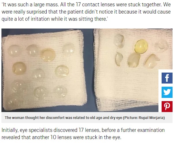 眼球から見つかったコンタクトレンズ（画像は『Metro　2017年7月15日付「Surgeons find 27 contact lenses lodged in woman’s eye」（Picture: Rupal Morjaria）』のスクリーンショット）