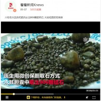 【海外発！Breaking News】脂っこいお肉が大好きな高齢女性　胆石800個を摘出（中国）