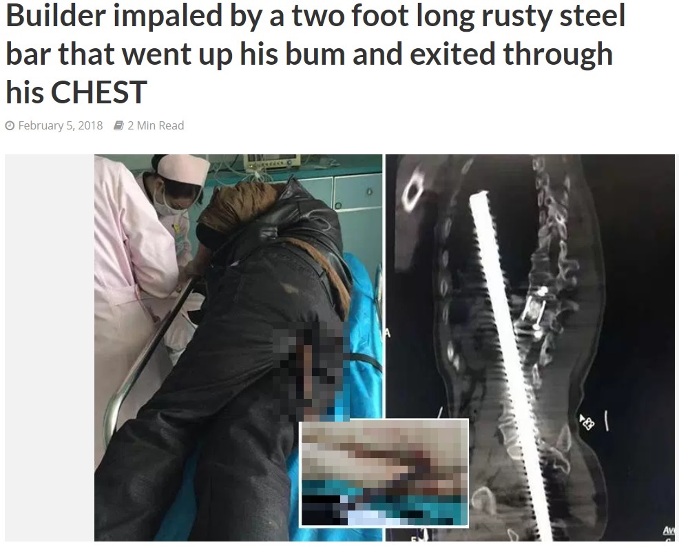 建設作業員の尻に鉄筋が突き刺さる（画像は『The Amed Post　2018年2月5日付「Builder impaled by a two foot long rusty steel bar that went up his bum and exited through his CHEST」』のスクリーンショット　画像を一部加工しています）