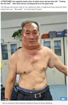 【海外発！Breaking News】長年の大量飲酒が原因か　68歳男性、脂肪腫で「超人ハルク」のように（中国）