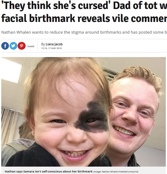 顔にあざを持って生まれたサマラちゃん（画像は『Daily Record　2018年5月17日付「‘They think she’s cursed’ Dad of tot with disfiguring facial birthmark reveals vile comments from trolls」（Image: Nathan Whalen/mediadrumworld）』のスクリーンショット）