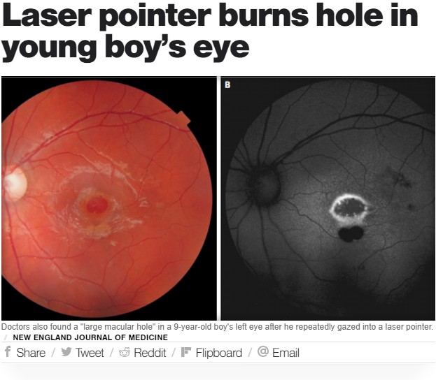 レーザーポインターを直視した9歳男児の眼球に穴が…（画像は『CBS News　2018年6月21日付「Laser pointer burns hole in young boy’s eye」（NEW ENGLAND JOURNAL OF MEDICINE）』のスクリーンショット）