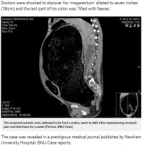 【海外発！Breaking News】極度の便秘で腸に穴　臓器不全の危機に直面した男性（英）