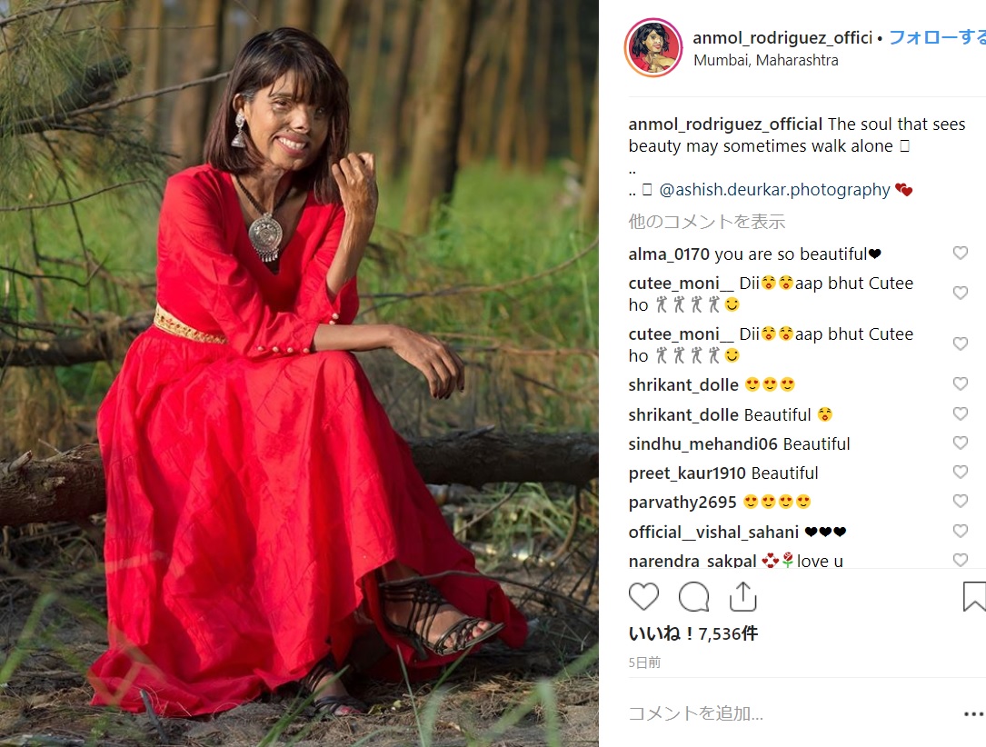 生後2か月の時に父親から酸攻撃を受けた女性（画像は『ANMOL　2019年1月4日付Instagram「The soul that sees beauty may sometimes walk alone」』のスクリーンショット）