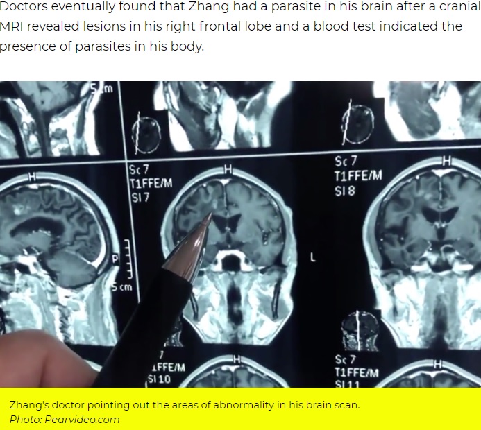 脳のスキャンで映し出された寄生虫（画像は『AsiaOne　2019年8月21日付「Worm lived in Chinese man’s brain for 30 years, causing headaches and seizures」（PHOTO:Pearvideo）』のスクリーンショット）