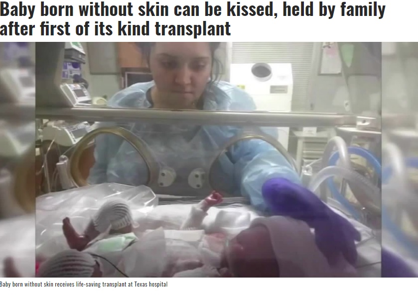 生後4か月で皮膚移植手術を受けた赤ちゃん（画像は『Cleveland 19 News　2019年10月10日付Baby born without skin can be kissed, held by family after first of its kind transplant」』のスクリーンショット）