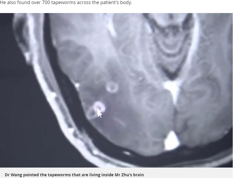 脳のなかにも寄生虫（画像は『Mirror　2019年11月20日付「Man found with 700 tapeworms in his brain, chest and lungs after eating pork」』のスクリーンショット）