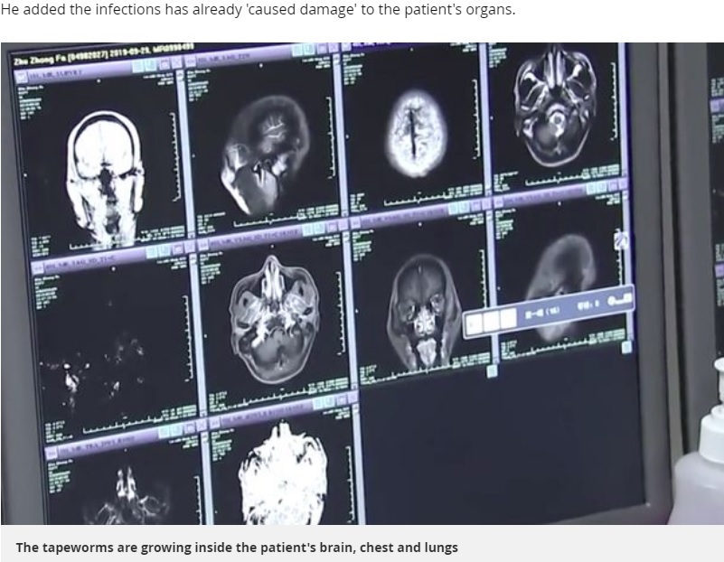 40代男性から700以上もの寄生虫が見つかる（画像は『Mirror　2019年11月20日付「Man found with 700 tapeworms in his brain, chest and lungs after eating pork」』のスクリーンショット）