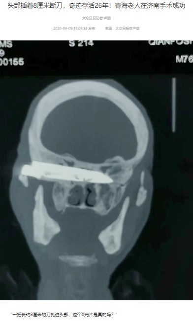 頭部内に映し出されたナイフ（画像は『大众日报　2020年4月9日付「头部插着8厘米断刀，奇迹存活26年！青海老人在济南手术成功」（素材来源/海北新媒千佛山医院）』のスクリーンショット）