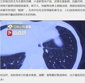 【海外発！Breaking News】カニ好きの男性　肺に細長い寄生虫が発見される（中国）