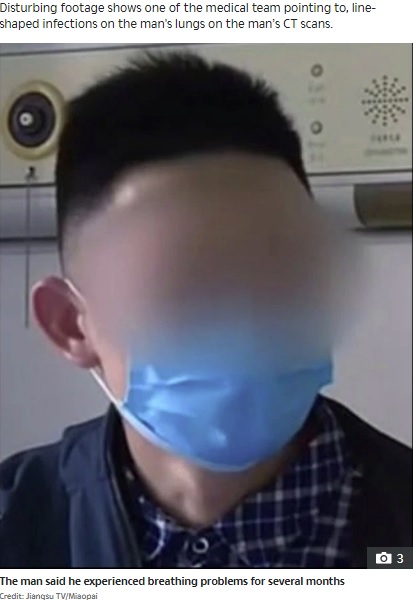 肺吸虫症に感染した男性（画像は『The Sun　2020年4月30日付「‘I CAN’T BREATHE’ Chinese man who gobbled live snakes now has lungs riddled with worms」（Credit: Jiangsu TV/Miaopai）』のスクリーンショット）