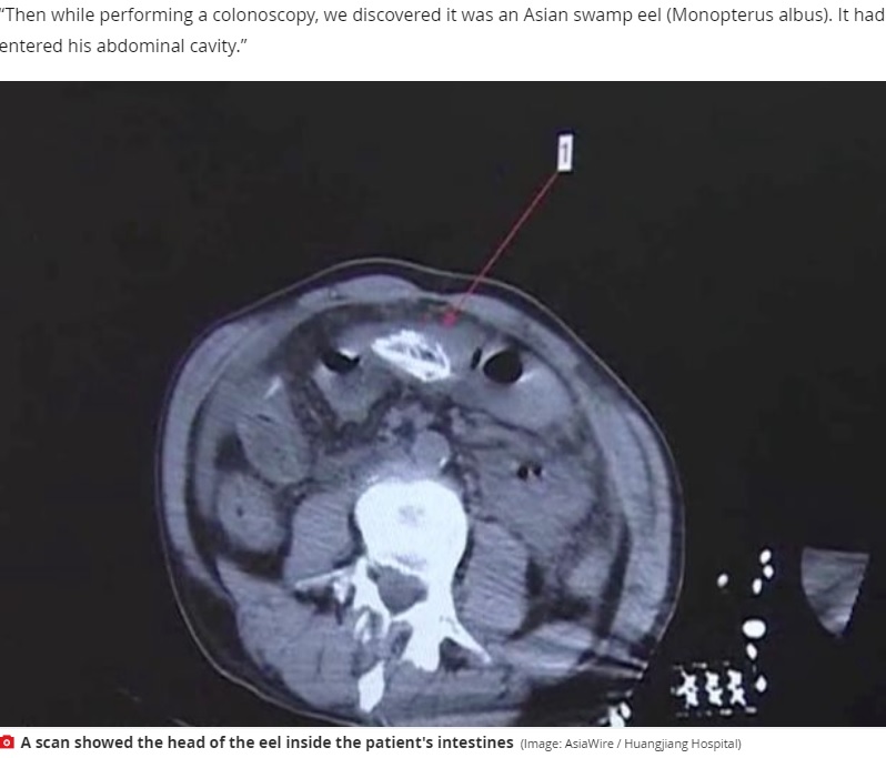 CTスキャンで映し出されたウナギの頭（画像は『Mirror　2020年6月23日付「Man inserts 15-inch eel into rear in ‘folk remedy’ before it tears hole in his bowels」（Image: AsiaWire / Huangjiang Hospital）』のスクリーンショット）