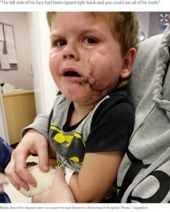 顔を縫う重傷を負ったマキシン君（画像は『NZ Herald　2020年7月2日付「Hastings dog attack leaves Christchurch boy with life-changing injuries」（Photo / Supplied）』のスクリーンショット）