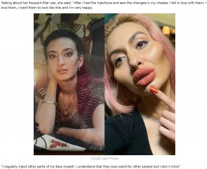 フィラー注入前と施術後のアナスタシアさん（画像は『LADbible　2020年6月25日付「Woman Loves Cheek Fillers So Much She Even Injects Them Herself」（Credit: Jam Press）』のスクリーンショット）