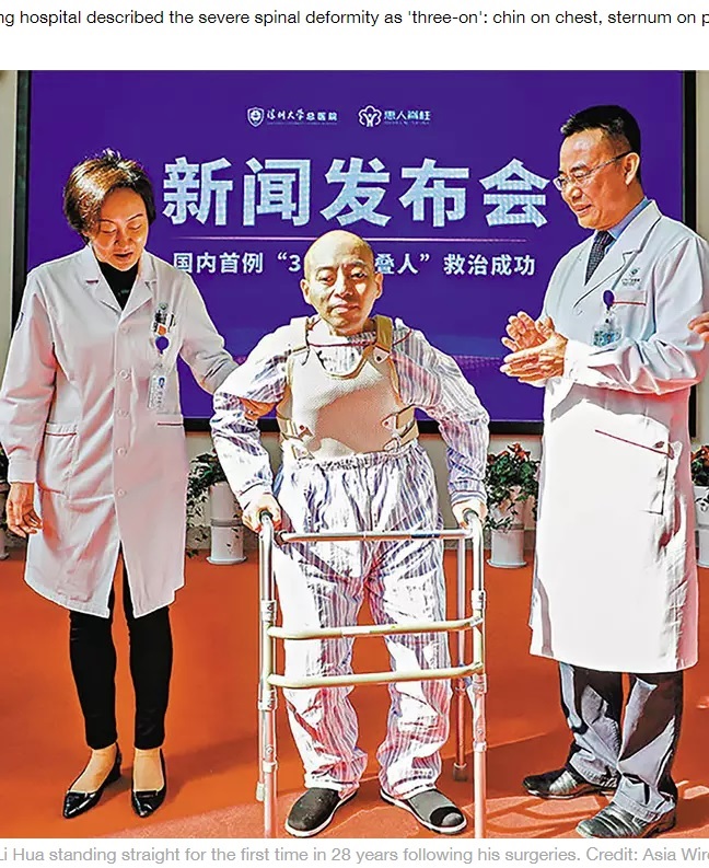 真っ直ぐ立てるようになった男性（画像は『LADbible　2019年12月16日付「Man Folded In Half Stands Straight After 28 Years」（Credit: Asia Wire）』のスクリーンショット）