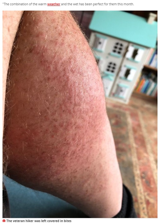 大量の虫刺されの痕が残るアランさんの脚（画像は『Mirror　2020年8月17日付「Man left covered in bites after midges swarm tent like ‘something from horror movie’」』のスクリーンショット）