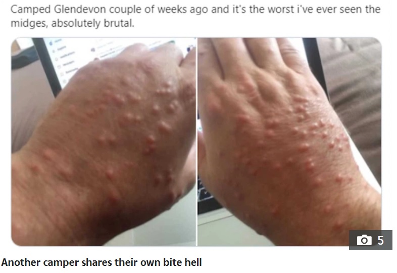 あるユーザーが投稿した虫刺されの痕（画像は『The Scottish Sun　2020年8月18日付「SWARMAGEDDON Scots camper shares skin-crawling video as ‘worst swarm of midges in 20 years’ attacks his tent」』のスクリーンショット）