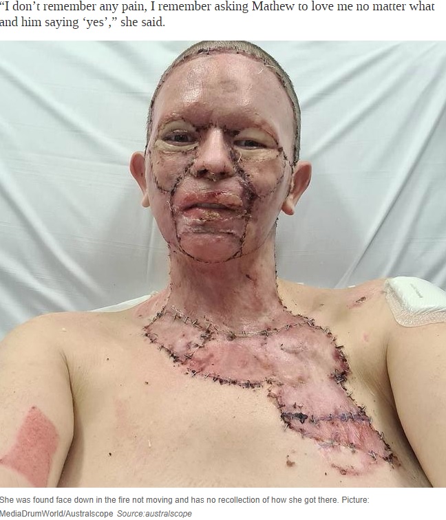 皮膚移植をして4日後のヘイリーさん（画像は『News.com.au　2020年8月20日付「Woman’s face ‘burned off’ in unexplained accident with campfire」（Picture: MediaDrumWorld/Australscope）』のスクリーンショット）