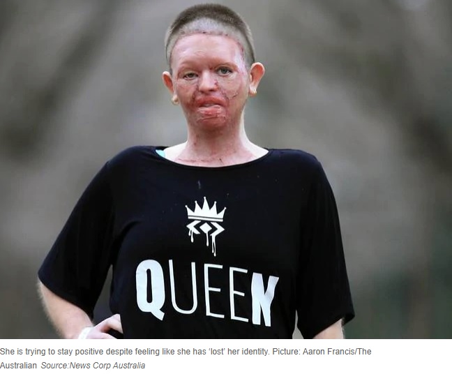 現在のヘイリーさん（画像は『News.com.au　2020年8月20日付「Woman’s face ‘burned off’ in unexplained accident with campfire」（Picture: Aaron Francis/The Australian）』のスクリーンショット）