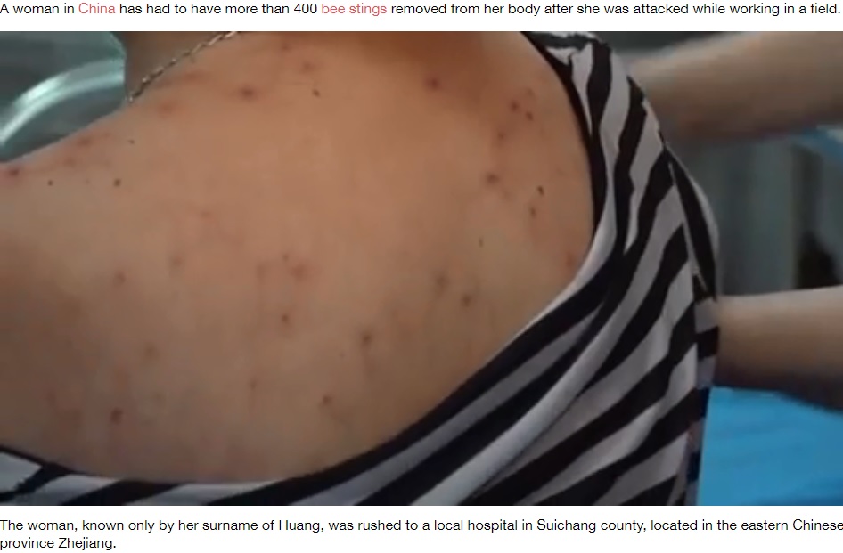 ハチに刺されたファンさんの背中（画像は『LADbible　2020年8月28日付「​Woman Has To Have More Than 400 Bee Stings Removed From Body」（Credit: Suichang News/WeChat）』のスクリーンショット）