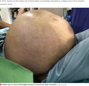 異様に膨れ上がったナーマラさんのお腹（画像は『Mirror　2020年8月22日付「Huge ovarian tumour weighing almost 8 stone removed from 52-year-old woman」（Image: supplied）』のスクリーンショット）