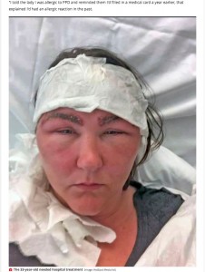 顔全体が大きく腫れてしまったニコラさん（画像は『Mirror　2020年10月28日付「Eyebrow tint almost killed woman and left her looking ‘like Space Raider alien’」（Image: HotSpot Media ltd）』のスクリーンショット）