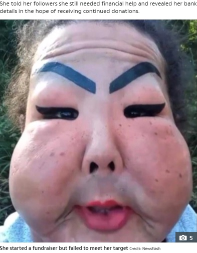 以前の面影は全くないジュジュさん（画像は『The Sun　2021年4月16日付「AN’T FACE IT Trans woman who injected industrial silicone into her face forced to live with droopy cheeks as she can’t afford ￡6k op」（Credit: Newsflash）』のスクリーンショット）