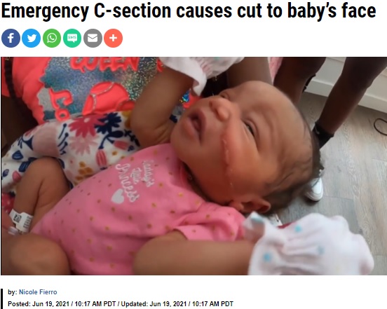 13針縫ったカヤーニちゃん（画像は『KRON4　2021年6月19日付「Emergency C-section causes cut to baby’s face」』のスクリーンショット）