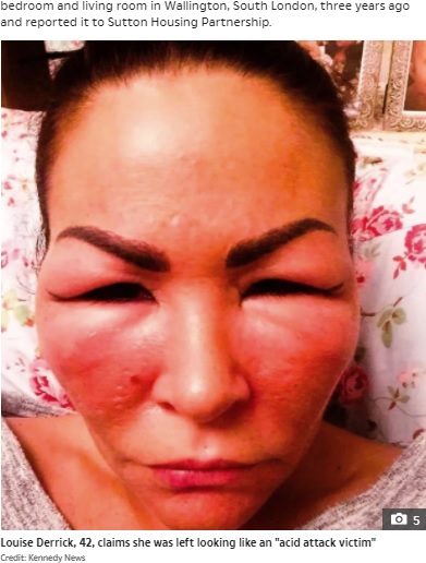 顔が腫れ上がってしまったルイーズさん（画像は『The Sun　2021年6月23日付「‘ABSOLUTE HELL’ Beautician left looking like ‘acid attack victim’ after untreated mould infestation ravages council flat」（Credit: Kennedy News）』のスクリーンショット）