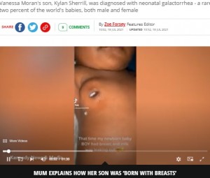 かなりの量の乳汁が出ていたキーラン君（画像は『Mirror　2021年7月18日付「‘My baby boy developed breasts and began leaking milk when he was week old’」（Image: Kennedy News and Media）』のスクリーンショット）