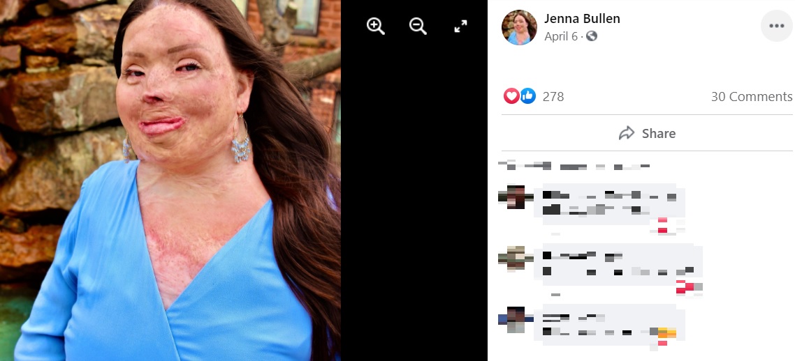 3歳で身体の95％に火傷を負った25歳女性（画像は『Jenna Bullen　2021年4月6日付Facebook』のスクリーンショット）