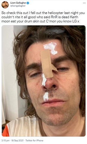 ヘリから落下し顔面を負傷したリアム（画像は『Liam Gallagher　2021年9月18日付Twitter「So check this out I fell out the helicopter last night you couldn’t rite it all good who said RnR is dead Keith moon eat your drum skin out C’mon you know LG x」」』のスクリーンショット）