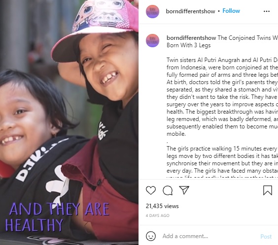 8歳になり元気な笑顔をみせる2人（画像は『Born Different　2021年9月28日付Instagram「The Conjoined Twins Who Were Born With 3 Legs」』のスクリーンショット）