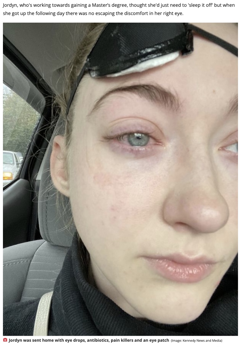 傷ついてしまった眼球（画像は『The Daily Star　2021年10月30日付「Make-up artist suffers Halloween horror after contact lens rips off layer of her eyeball」（Image: Kennedy News and Media）』のスクリーンショット）