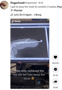 男性が医師から見せられたX線写真（画像は『fingerhook1　2021年10月12日付TikTok「I get to keep the hook for another 2 weeks」』のスクリーンショット）