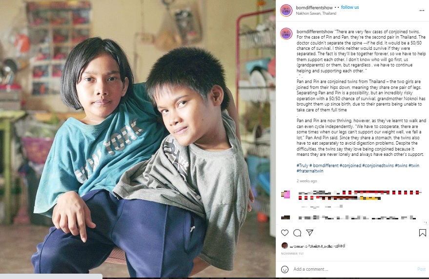 分離しない決断をした結合双生児の姉妹（画像は『Born Different　2021年11月1日付Instagram「There are very few cases of conjoined twins.」』のスクリーンショット）