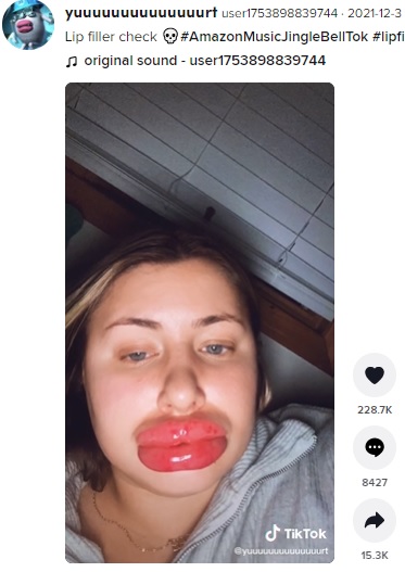 茹でたソーセージを2本並べたような唇（画像は『user1753898839744　2021年12月3日付TikTok「Lip filler check」』のスクリーンショット）