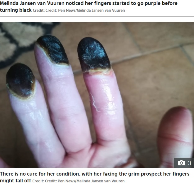 黒くなり壊死した指先（画像は『The Mirror　2022年3月17日付「Woman’s fingers turn black and are close to falling off after years of smoking」（Image: Credit: Pen News/Melinda Jansen van Vuuren）』のスクリーンショット）