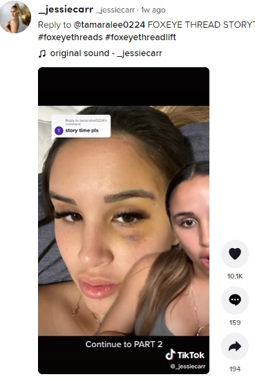 目の下にできた青あざ（画像は『_jessiecarr　2022年3月4日付TikTok「Reply to ＠tamaralee0224 FOXEYE THREAD STORYTIME」』のスクリーンショット）