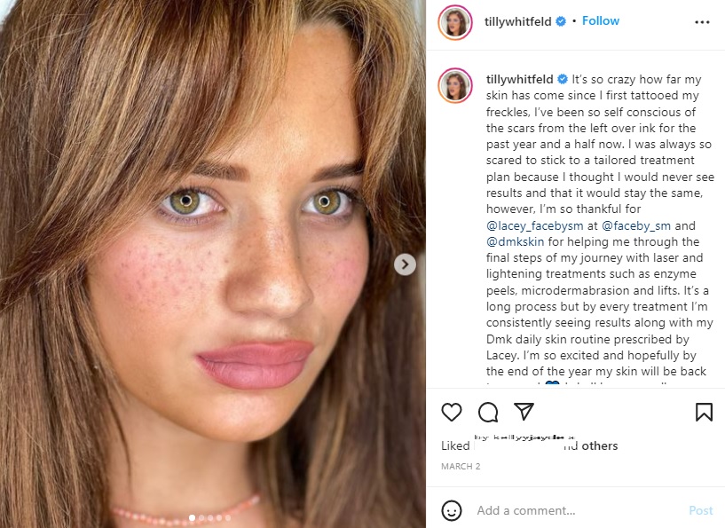 ソバカスのDIYタトゥーから約1年半が経った女性（画像は『paris 4 president　2022年3月2日付Instagram「It’s so crazy how far my skin has come」』のスクリーンショット）